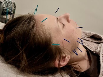 ネクサス(NEXUS)の写真/【鍼灸×整体】◇美容鍼では食いしばり、小顔ケアやお肌の悩み解消◎首肩の蓄積した疲労や不調を改善