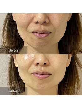 モンレーヴ/気になり始めたエイジンングに！