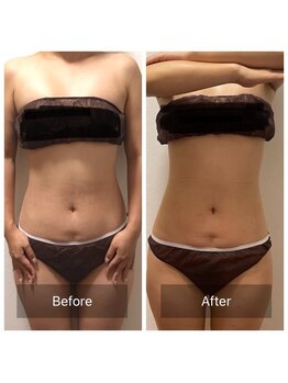 ヒール(heal)/インディバ 10回施術変化