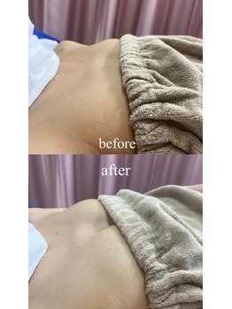 ビウラ(BIURA)/【20代】5回コース