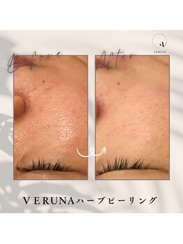 ココ 2号店(CoCo)/毛穴撲滅/ハーブピーリング