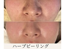 ミウ(MIU)/【 ハーブピーリング 】