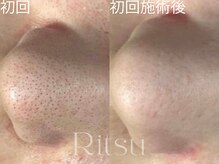 リツ(Ritsu)/毛穴洗浄