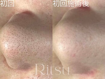 リツ(Ritsu)/毛穴洗浄