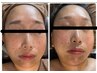 切らないフェイスリフト小顔&頭蓋骨調整+美容液導入90分30000→12800
