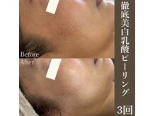 サロンドペシェ(salon de peche)/徹底美白乳酸ピーリング3回