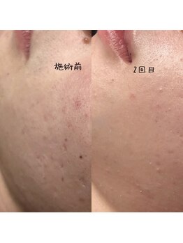 ディオーネ 大宮店(Dione)/【40代】毛穴・ニキビ・凹み