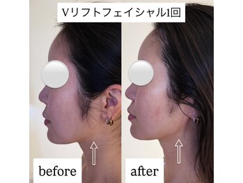 クラン(CLAN)/輪郭形成にVリフトフェイシャル