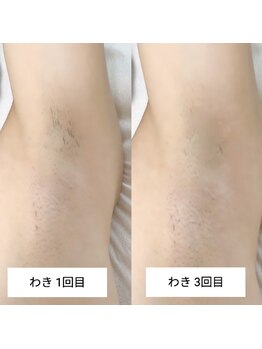 エムスリー(m3)/わき脱毛