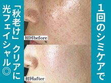 ティーツリー 名古屋 桜山(Tea Tree)/１回のシミケアフェイシャルで