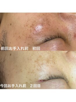 オードリー(Audrey)/光美容で肌質改善
