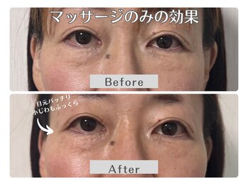 ルリアン(Lurian)/1回でのBefore→After