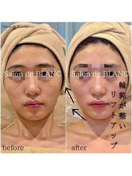 サロン ド ブラン アオヤマ(Salon de BLANC AOYAMA)/クリスティーナ美白ケア