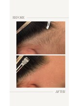 ムー 表参道店(mou)/うなじダブル脱毛before&after 