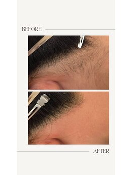 ムー 表参道店(mou)/うなじダブル脱毛before&after 