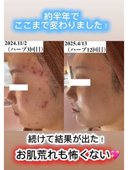 ホワイトアクア 四日市店(WHITE AQUA)/ハーブピーリング四日市