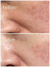 プレジール(Plaisir)/韓国美容皮膚科No.1ピール+LDM