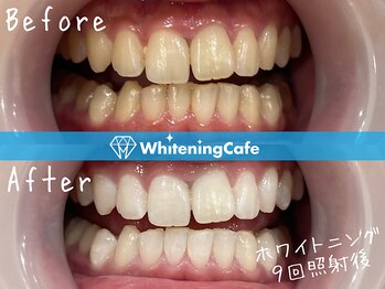 ホワイトニングカフェ 神戸元町店(WhiteningCafe)/ホワイトニングビフォーアフター