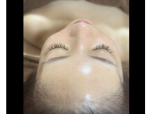 揺らぎ肌、赤み、ニキビ繰り返す肌を安定した肌へ