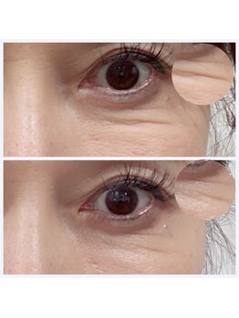 ブレア(Blair)/アルジルリン×LDE光