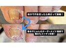 自分で切った爪が刺さって激痛に