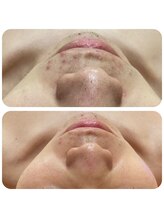 ルアナ(LUANA)/ハイドロピーリング水素水毛穴