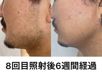 アマンビューティーリゾート/脱毛例