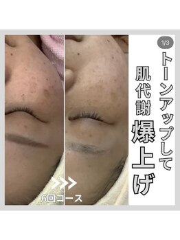 じゅえる/シミケア10分6回の効果 次へ→