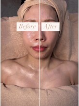 アンシャンテ(ENCHANTER)/小顔フェイシャル