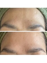 ルミエール パークサイド(L’MIERE parkside)/毛穴ケアによる黒ずみの肌変化