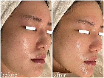 リリィブラン(Lily branc)/毛穴ニキビケア/小顔/美白