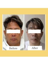 クローバー(clover)/【before/after】施術3回目翌日