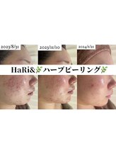 ハリト エステ(HaRi&)/毛穴洗浄/熊本/ハーブピーリング