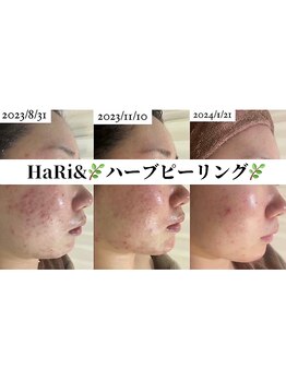 ハリト エステ(HaRi&)/毛穴洗浄/熊本/ハーブピーリング