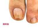 長年抱えていた爪のトラブル