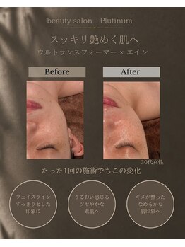 Beauty Salon Platinum 藤沢店　～フェイシャル＆痩身～の写真/【NEW OPEN★エイジングケア】たるみ・ハリ不足に☆丁寧なカウンセリングでピンッと弾むような若々しい肌へ