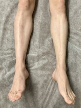 ヴィプラス(VIPLUZ)/人気の脚丸ごと脱毛！