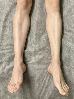 ヴィプラス(VIPLUZ)/人気の脚丸ごと脱毛！