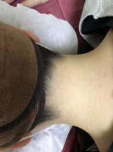 アロマベリー(AromaBerry)/うなじの美肌脱毛