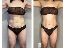 ブリス(bliss)/ウィンバック痩身５回の効果