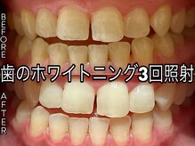 ヴィオール 名古屋栄店(VIOR)/ホワイトニング後ツヤ誕生！