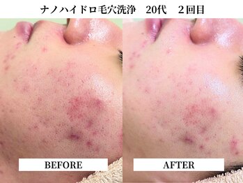 サンビ(SANBI)/赤みのある肌荒れ・黒ずみ毛穴に