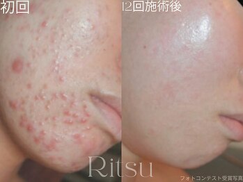 リツ(Ritsu)/停滞ニキビケア