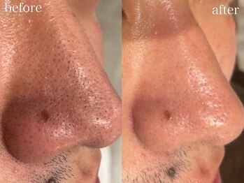 アワピール 天王寺店(AWA PEELL)/毛穴洗浄/天王寺/毛穴洗浄/小顔