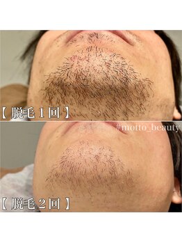 モット 神戸店(Motto)/ヒゲ脱毛