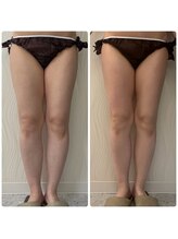 ソルニス(Solnis.)/痩身☆脂肪分解/ハイパーナイフ