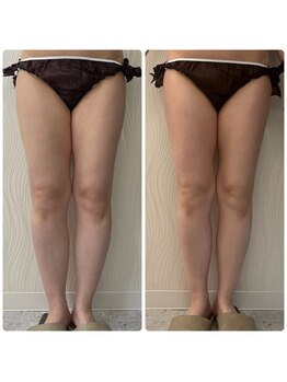 ソルニス(Solnis.)/痩身☆脂肪分解/ハイパーナイフ