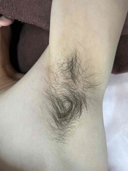 エルミューノ(elμno)/ワキ脱毛 ビフォー