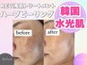 【毛穴・ニキビケア・赤み】REVIハーブピーリング+ 高濃度ビタミンC美容液