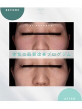 エーティーセンターラボ(At.center labo)/結果の出るシミプログラム